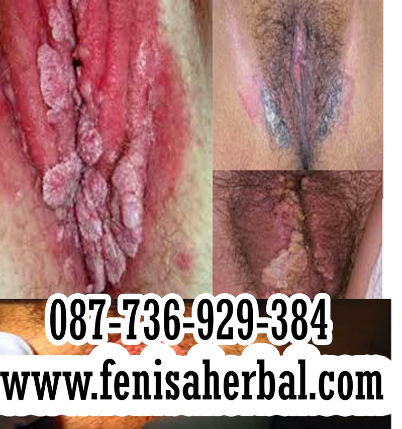 Illustration for article titled Obat Alami Kutil Kelamin